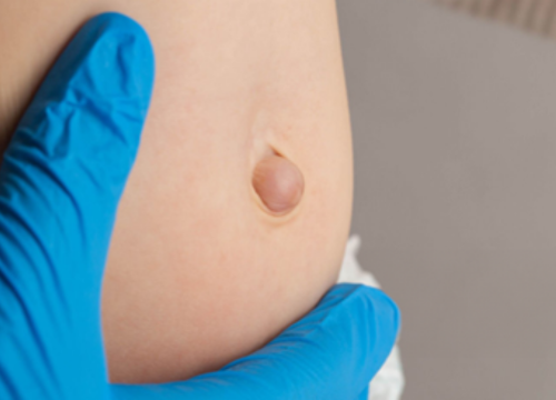 s3 Hernias (Inguinal, Ventral, Hiatal and Complex Hernias)