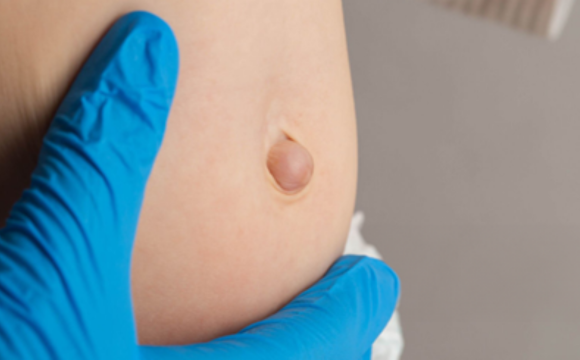 Hernias (Inguinal, Ventral, Hiatal and Complex Hernias)