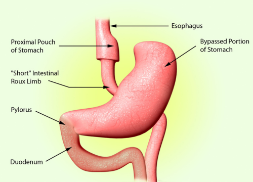 Roux-En-Y Gastric By-Pass