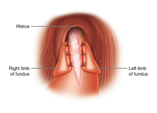Difficulty in Swallowing