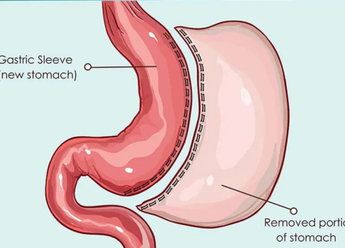 Sleeve Gastrectomy