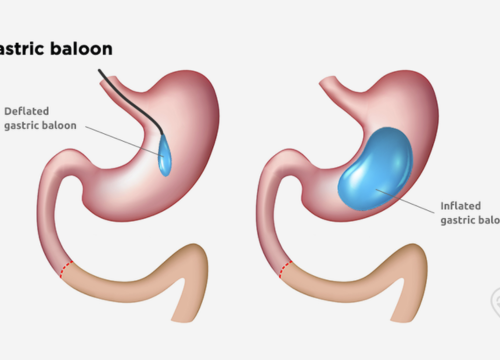 Gastric Ballon