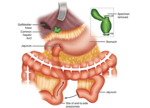 Choledochocystectomy
