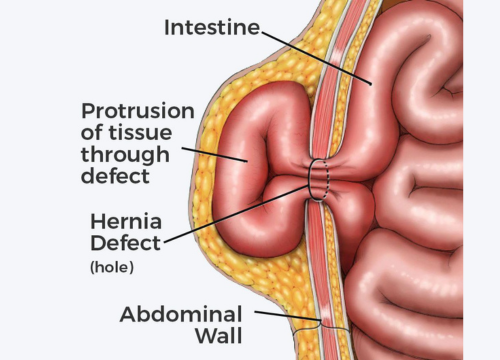 Inguinal & Ventral Hernia Repair