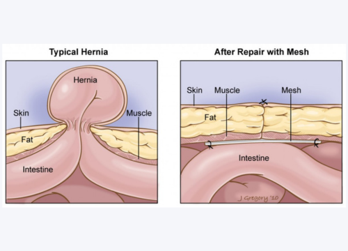 Complex Hernia Repair