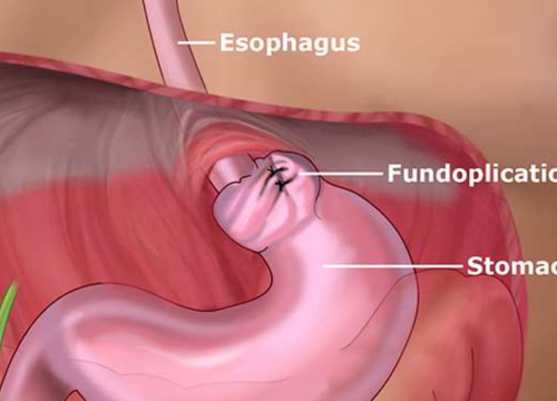 Nissen’s Fundoplication