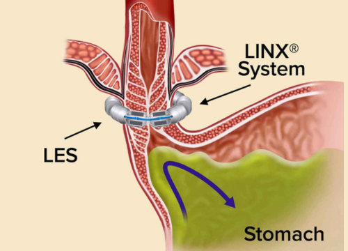 Toupet’s Fundoplication